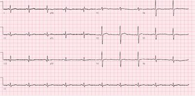 Giant left coronary artery diagonal branch left ventricular fistula: A case report and review of literature